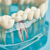Root canal treatment