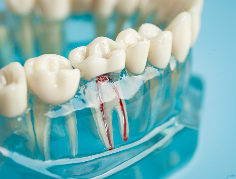 Root canal treatment