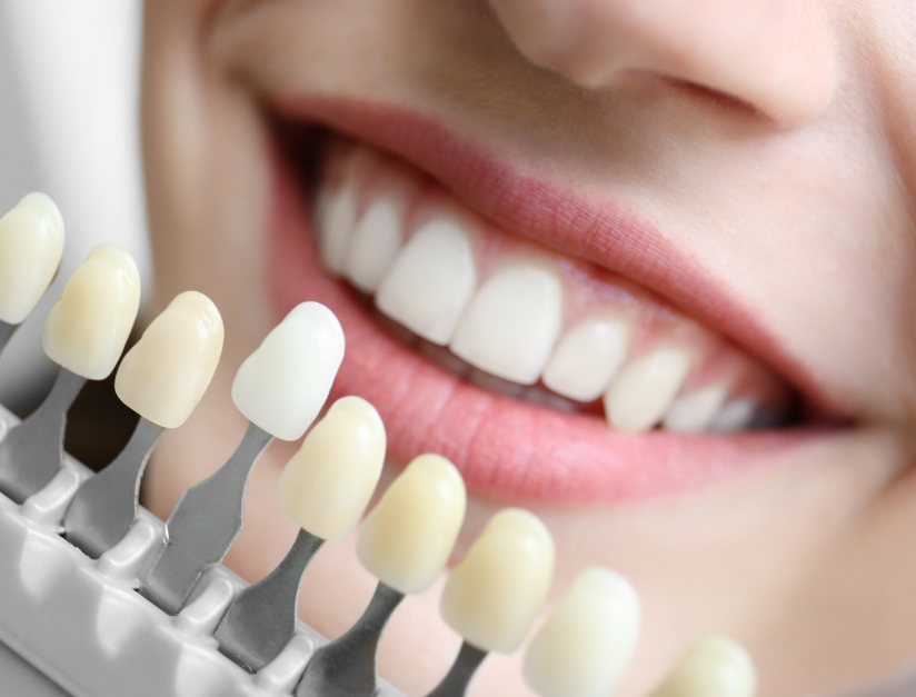 Teeth Whitening in Kanpur