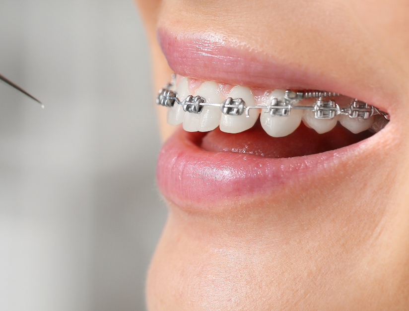 Dental braces in kanpur