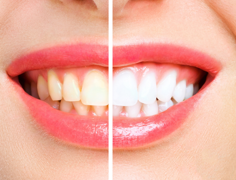 Benefits of Teeth whitening