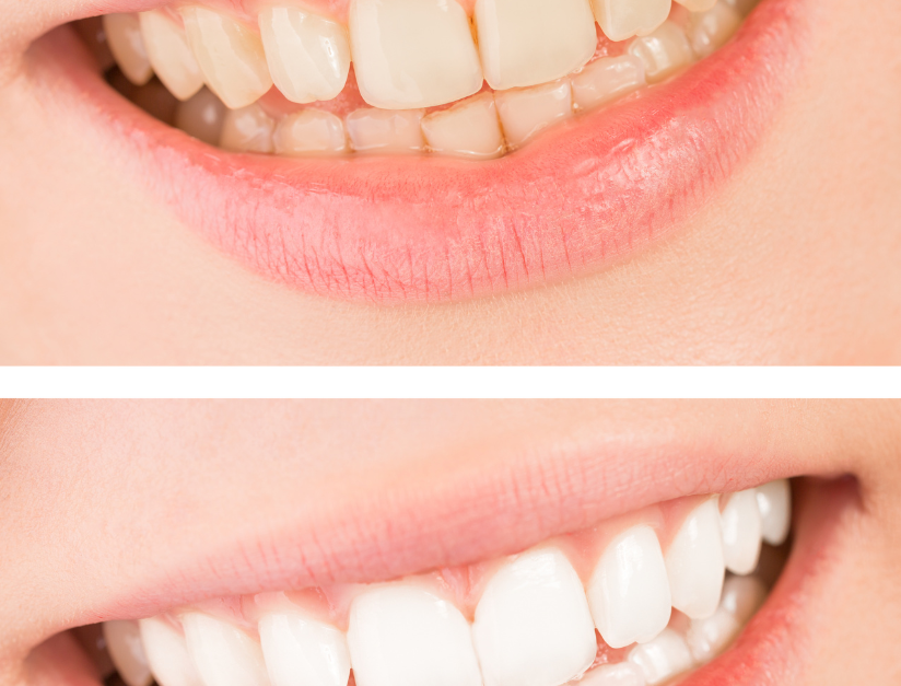 Veneers vs. Teeth Whitening: Which Cosmetic Treatment Is Right for You?