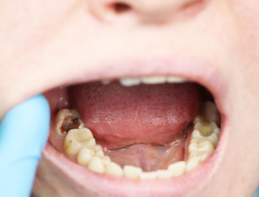 Prevent Cavities Naturally. Dental care tips and healthier smile