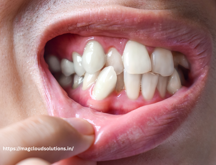Why Are My Teeth Shifting as an Adult?” – Causes and How to Stop It