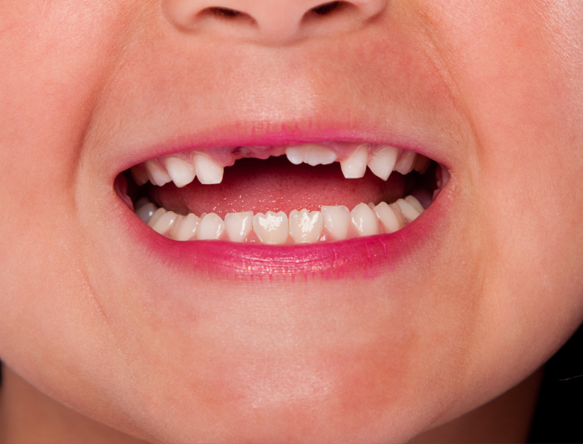 The Importance of Replacing Missing Teeth Promptly