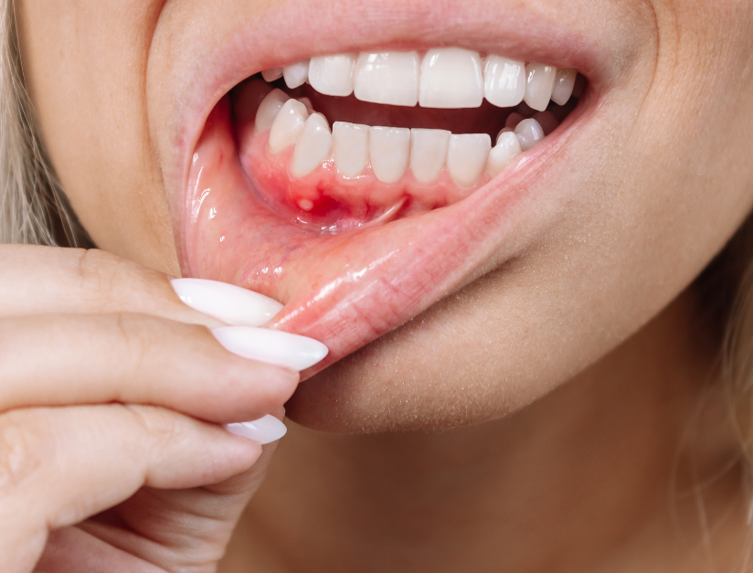 Why Do My Gums Bleed When I Brush