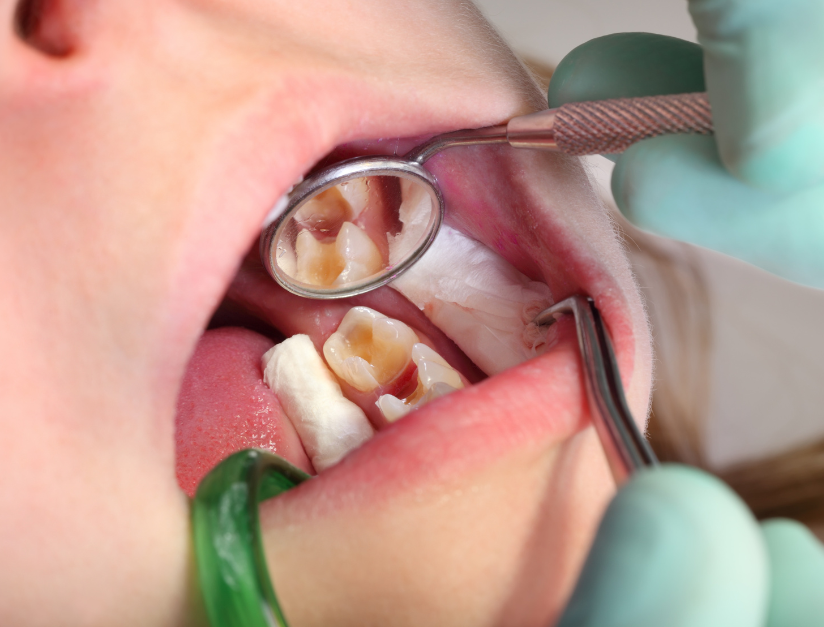 What Is a Cavity and How Fast Can It Spread
