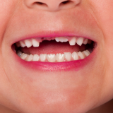 The Importance of Replacing Missing Teeth Promptly
