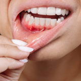 Why Do My Gums Bleed When I Brush