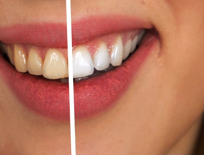 Safe Teeth Whitening in Kanpur