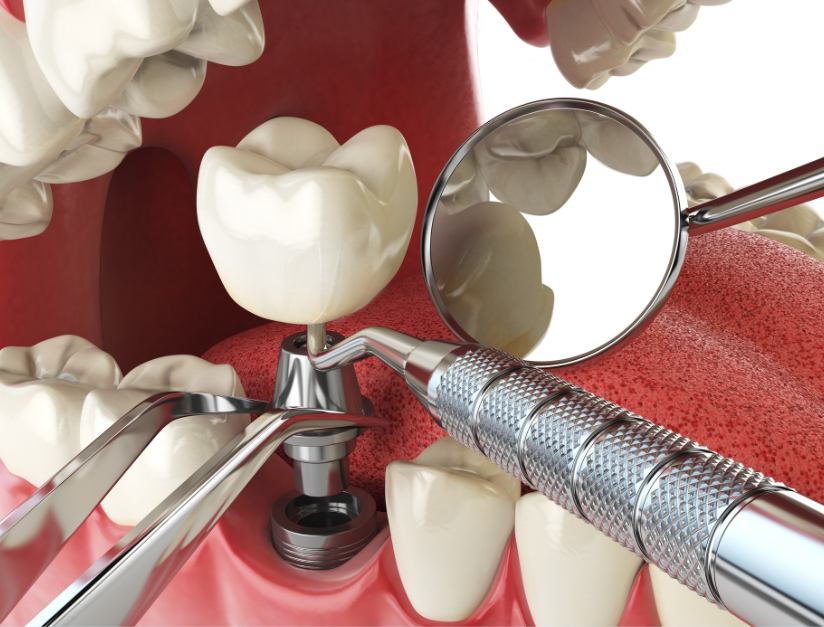 Let’s Discuss Dental Crown Types