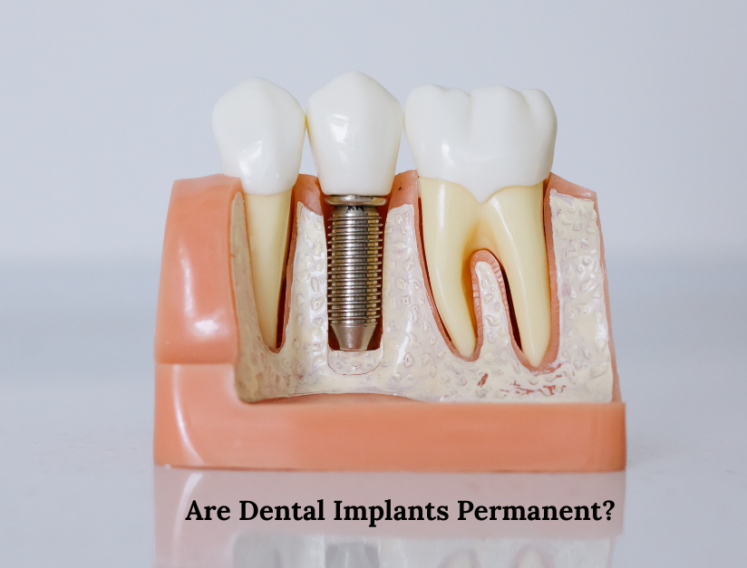 Are Dental implants Permanent? A Complete Guide