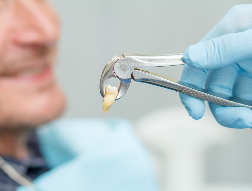 What to Eat After a Tooth Extraction