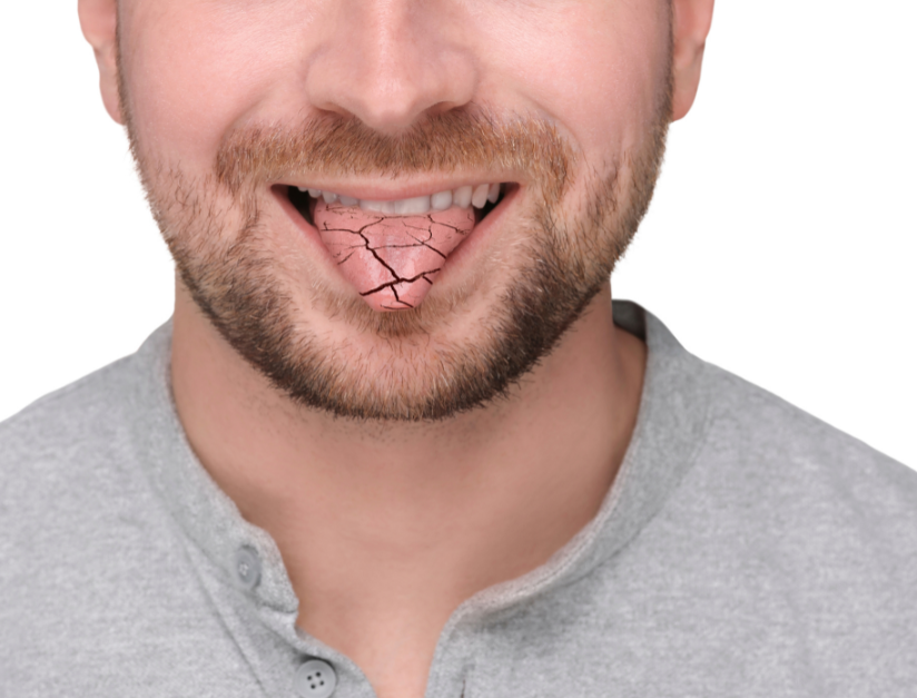 Understanding Dry Mouth (Xerostomia